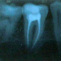 root canal